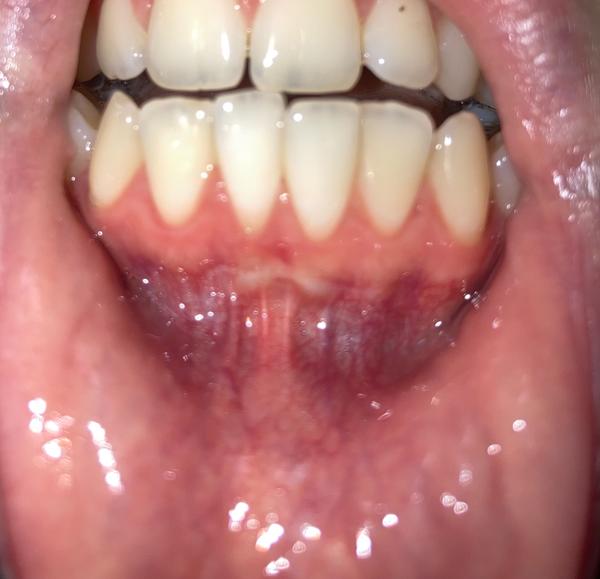 Mám zápal ďasien?