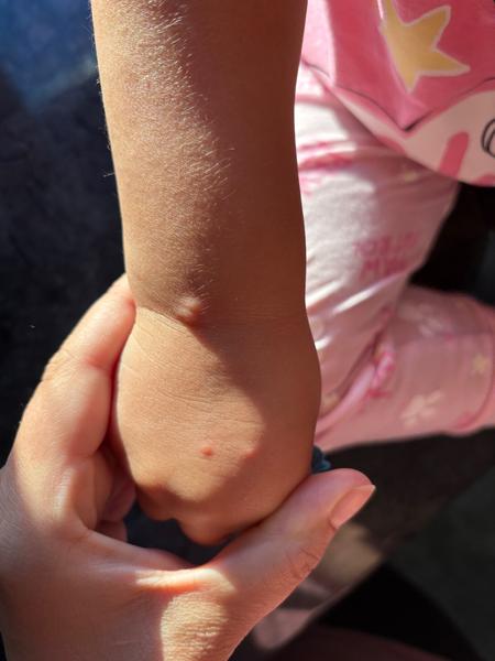 Sú to kiahne alebo štípance?