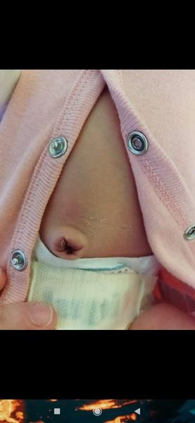 Je tento pupok zapálený?