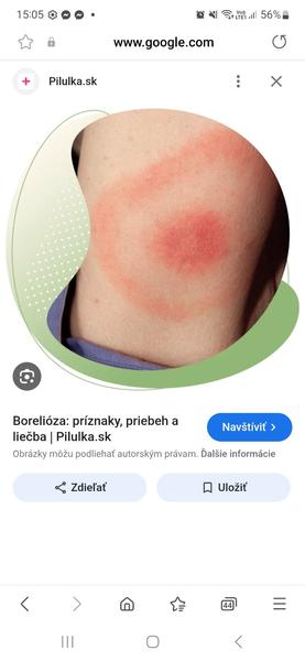 Ako rozpoznať príznaky boreliózy po uhryznutí kliešťom?