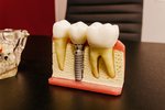 Zavádzanie zubného implantátu: Je to nepríjemné?
