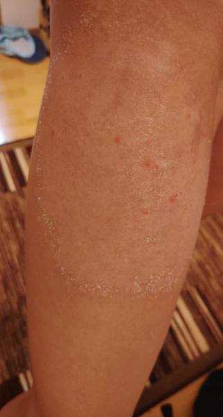 Čo spôsobilo vyrážky po návrate z Turecka?