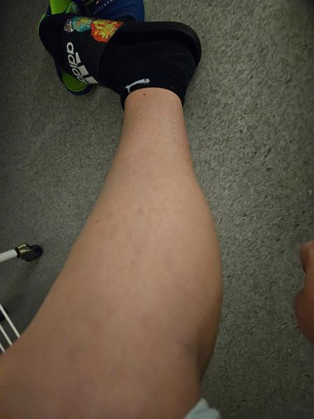 Prečo môže lýtko opuchnúť a bolieť?