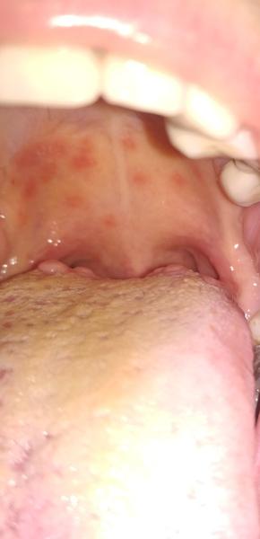 Z čoho mám bolesť hrdla, pálenie jazyka a červené škvrny na podnebí?