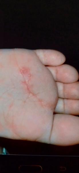 Má môj syn pleseň na chodidlách?