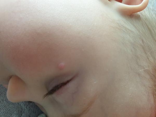 20 mesačný synček má pod okom už tri mesiace vyrážku. O aký problém ide?