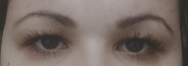 Pomohol by mojim horným viečkam fibroblast?