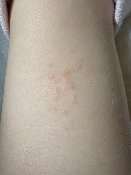 Kožná reakcia po pobyte vonku u detí