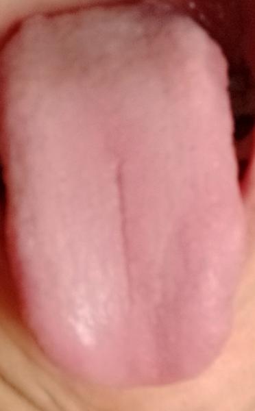 Sú papily na jazyku neškodné?