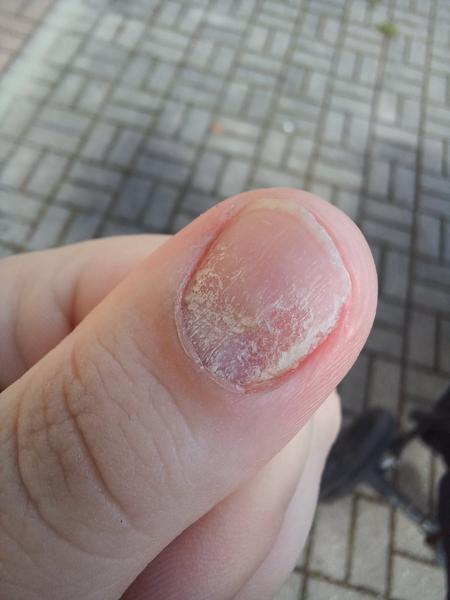 Čo spôsobuje zmeny vzhľadu nechtu?