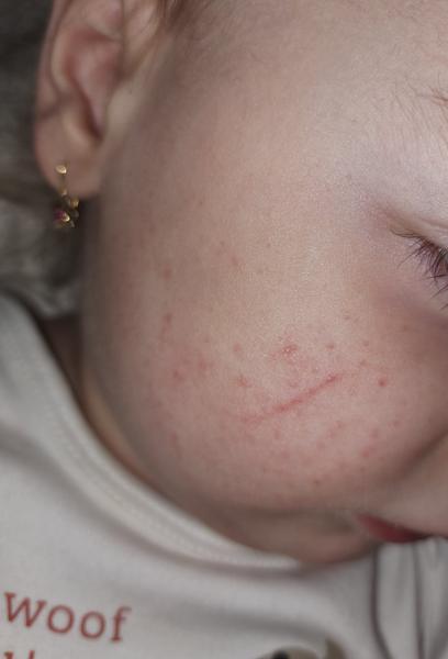 Z čoho sa mohli 2-ročnej dcérke vytvoriť takéto vyrážky?