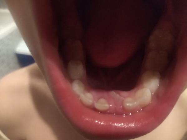 Ako postupovať, keď sa 7 ročnému synovi tlačí trvalý zub úplne mimo?