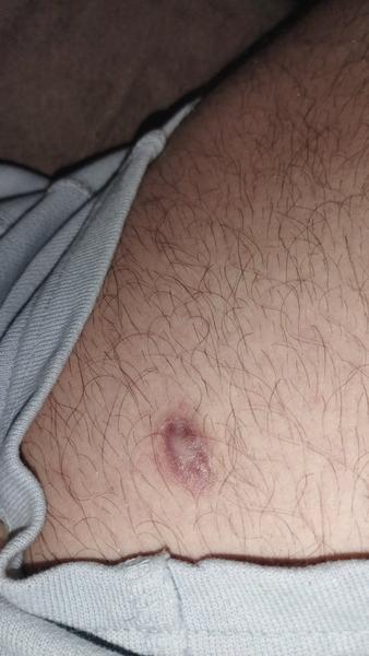 Čo to je na stehne?