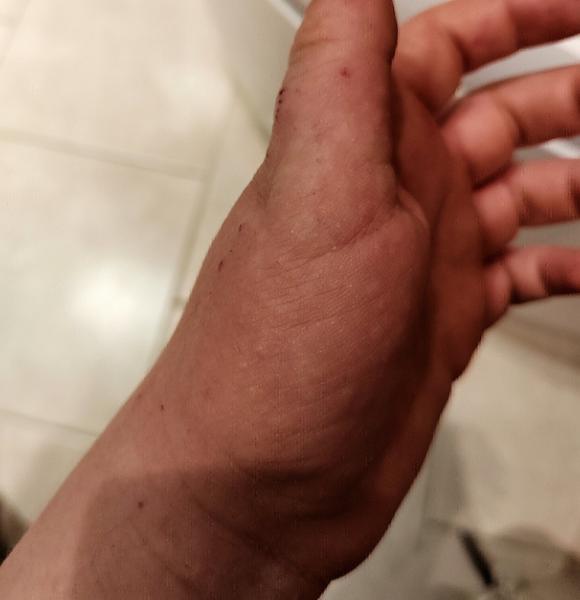 Svrbenie dlaní, prstov a vyrážky