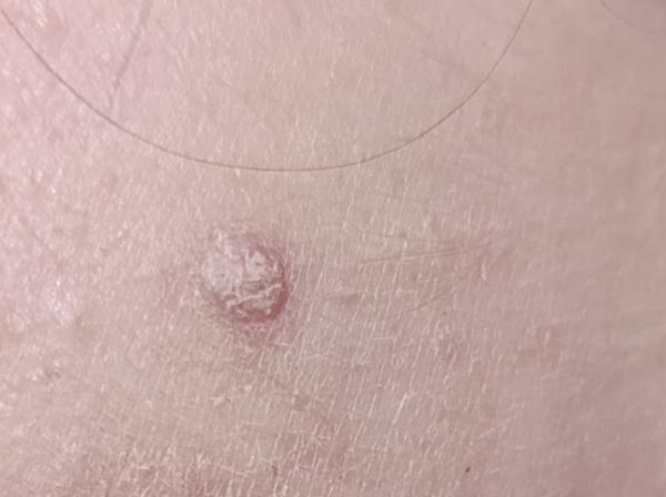 Čo môže spôsobovať suchú a šupinatú kožnú léziu?