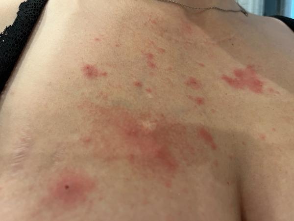 Ráno som sa zobudila s ekzémom na hrudi