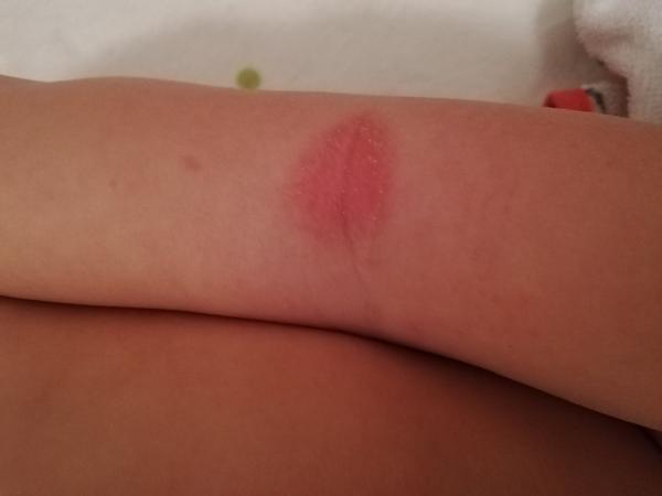 Červené suché fľaky na lakťových záhyboch u 17-mesačnej dcéry