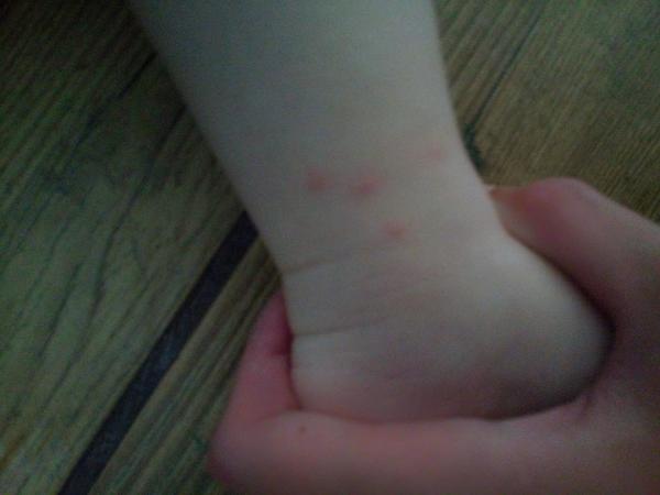 Vyrážky u dieťaťa