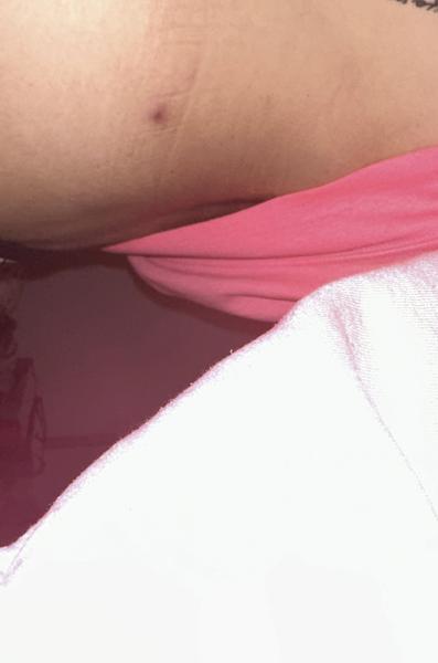 Neznámy podkožný pupák na bruchu a chrbte