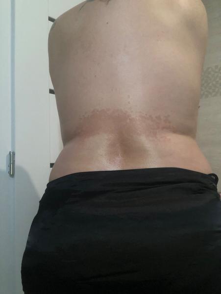 Aký fľak mi vznikol na chrbte po kyretáži?