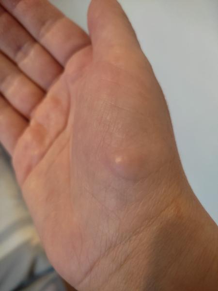 Je to podkužný tuk?