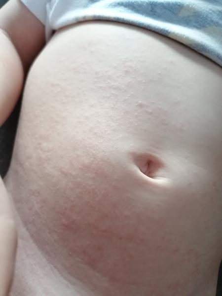 Aké vyrážky má môj syn?