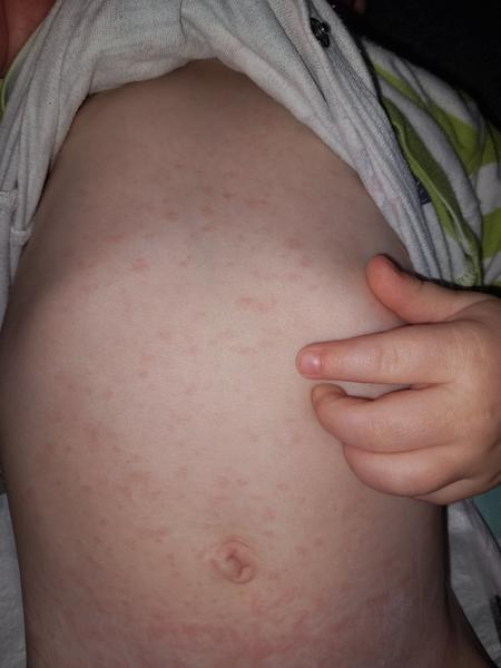 Vyrážky iba na hrudníku a pod plienkou