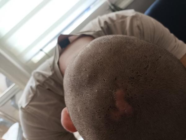 Chirurgický zákrok - odstránenie akné vo vlasoch