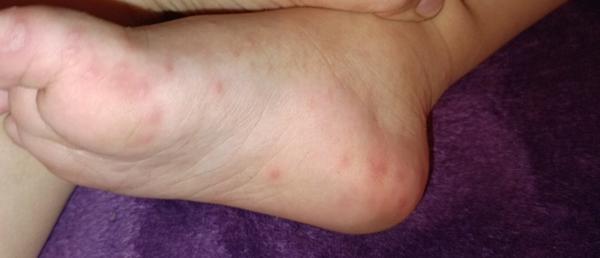 2-ročný chlapec má vyrážky. Ide o alergiu?