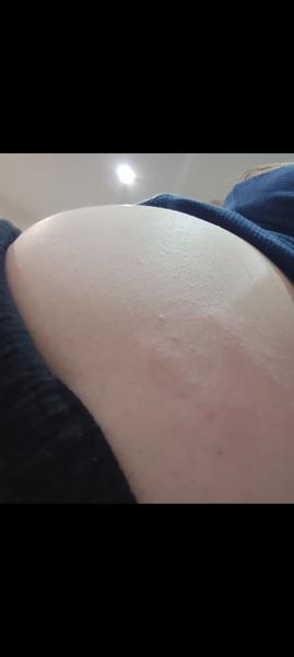 Čo spôsobuje svrbenie po vyrážkach?