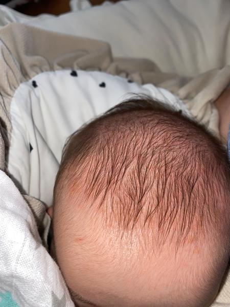 Spôsobila fľaky na hlavičke 2-mesačného bábätka kozmetika?