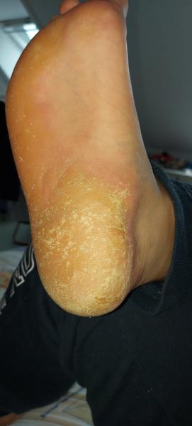 Mykóza alebo ekzém