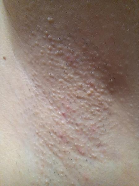 Čo sú to biele pupáčiky pod pazuchami?