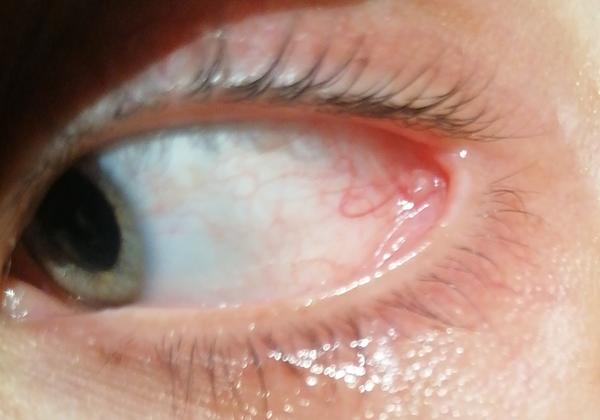 Niečo sa mi urobilo v oku