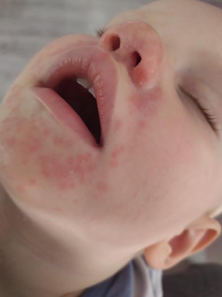 Z čoho má 1,5-ročný syn podráždenú pokožku v oblasti úst a nosa?