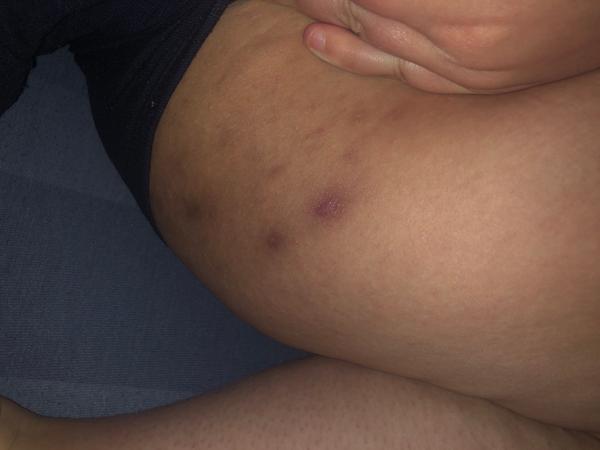 Aké vyrážky mám medzi stehnami?