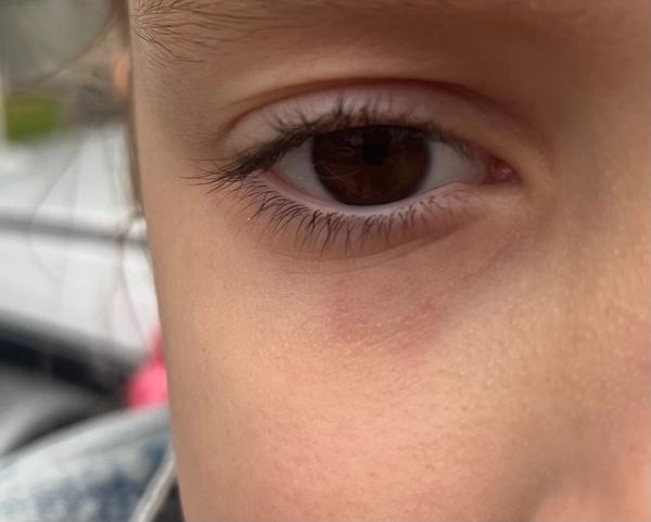 Čo môže spôsobovať červené oči u detí?