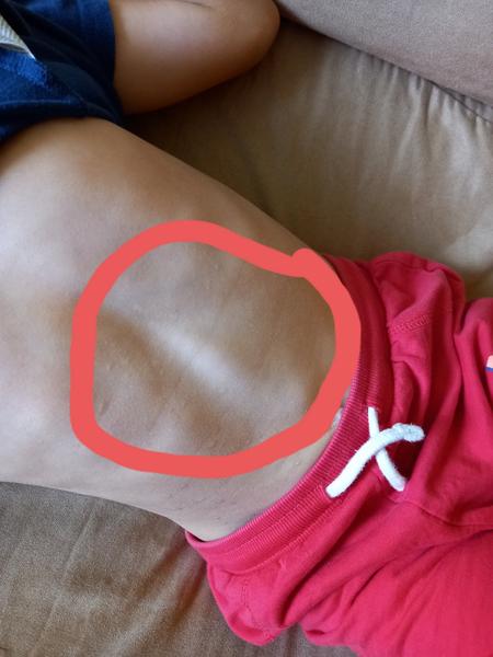 Diastáza u 5 ročného syna