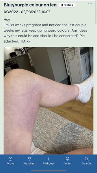 Zafarbenie pokožky a červeň v tvári počas tehotenstva: Ako to riešiť?