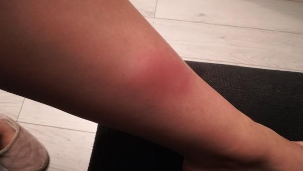 Môže to byť trombóza?