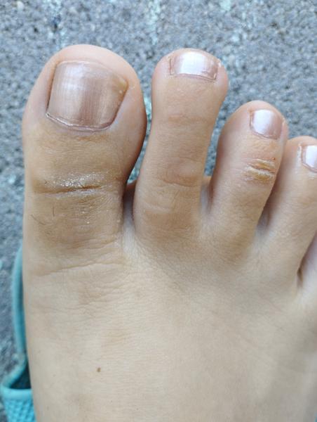 Suché miesta na nohách