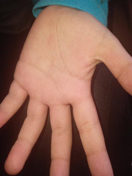 Syn má po troch týždňoch opäť angínu