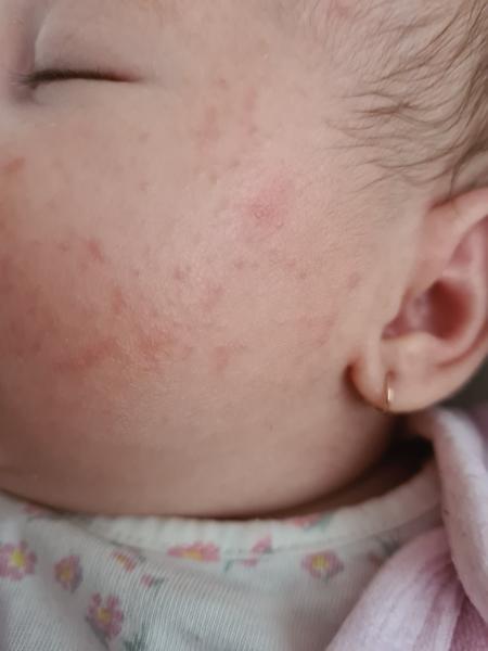 Aké fľaky a pupáčiky má moja skoro dvojmesačná dcérka?