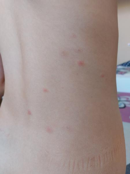 Znamenajú fľaky na tele alergiu?