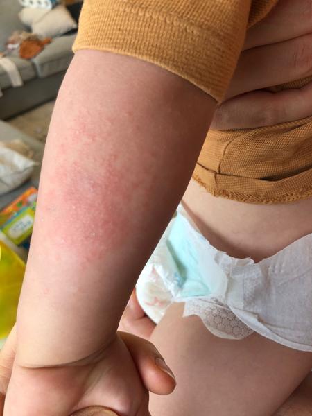 Poprhlenie 2-ročného dieťaťa