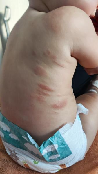 Čo môžu znamenať vyrážky u ročnej dcéry?