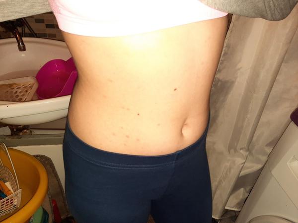 Aké vyrážky má moja dcéra na chrbte a na bruchu?