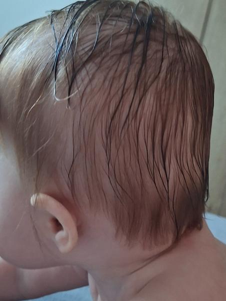 Skúsenosti so zlezenou hlavičkou u bábätka