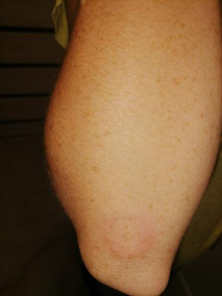 Čo ma mohlo uštipnúť?