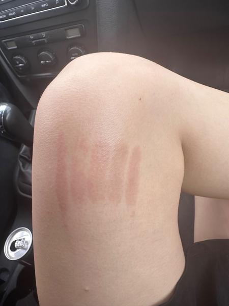 Ako ošetriť popáleninu spôsobenú naparovačkou?